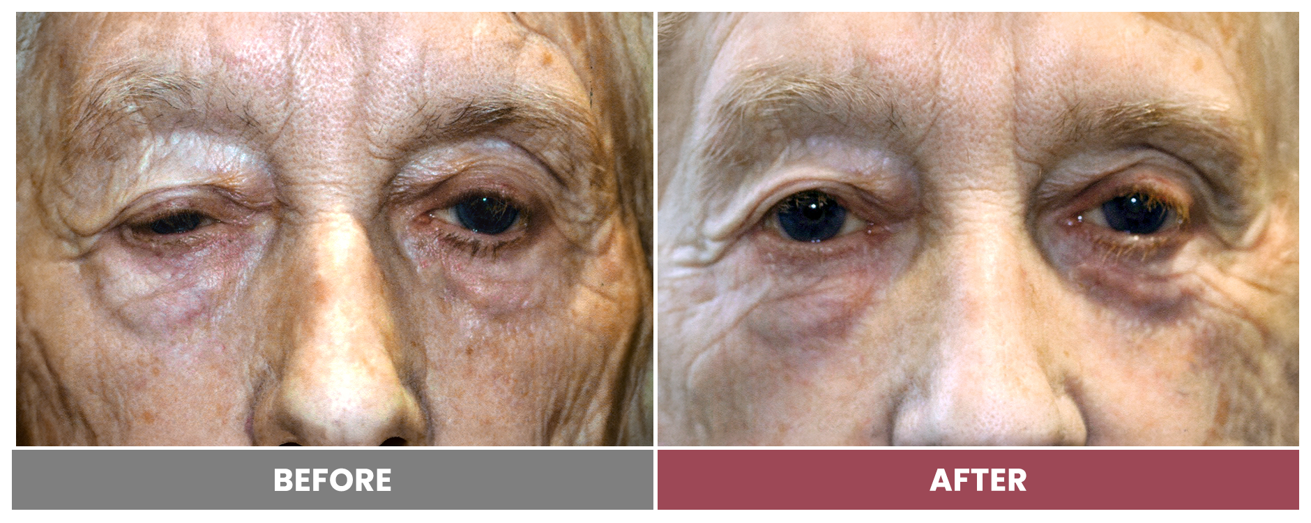 PTOSIS REPAIR - Case 39